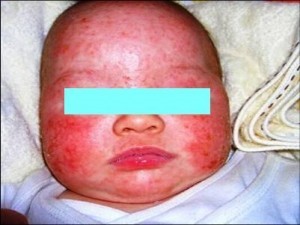 赤ちゃんのアトピーがこんなによくなりました