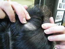 女性の抜け毛、薄毛、円形脱毛症の対策・２