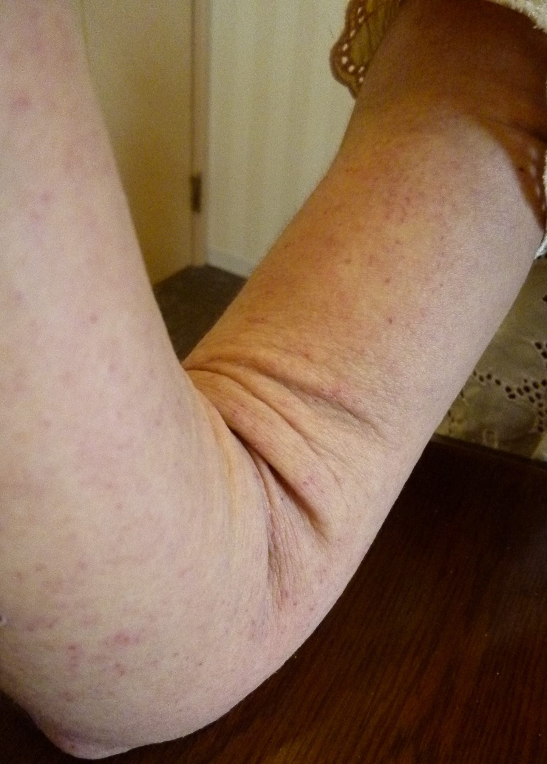 漢方で、むくんでぶよぶよの腕がすっきり改善