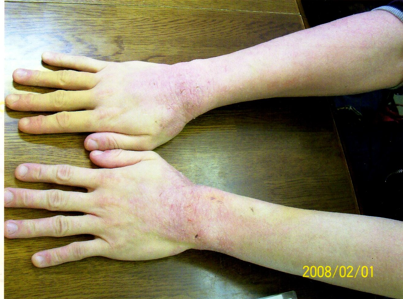 頑固な手首のアトピーも良くなりました。