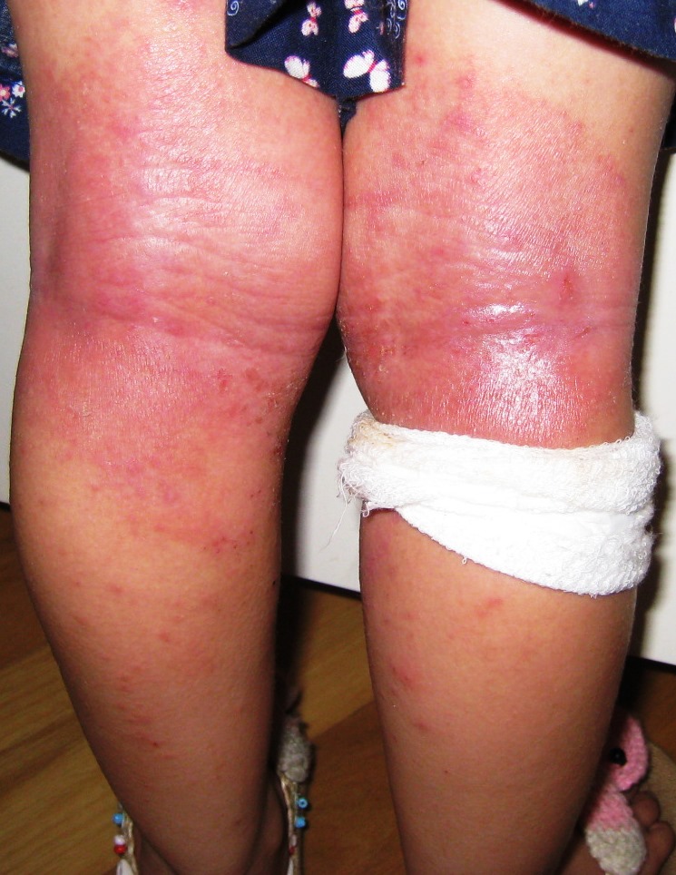 膝と肘のアトピーが漢方で改善