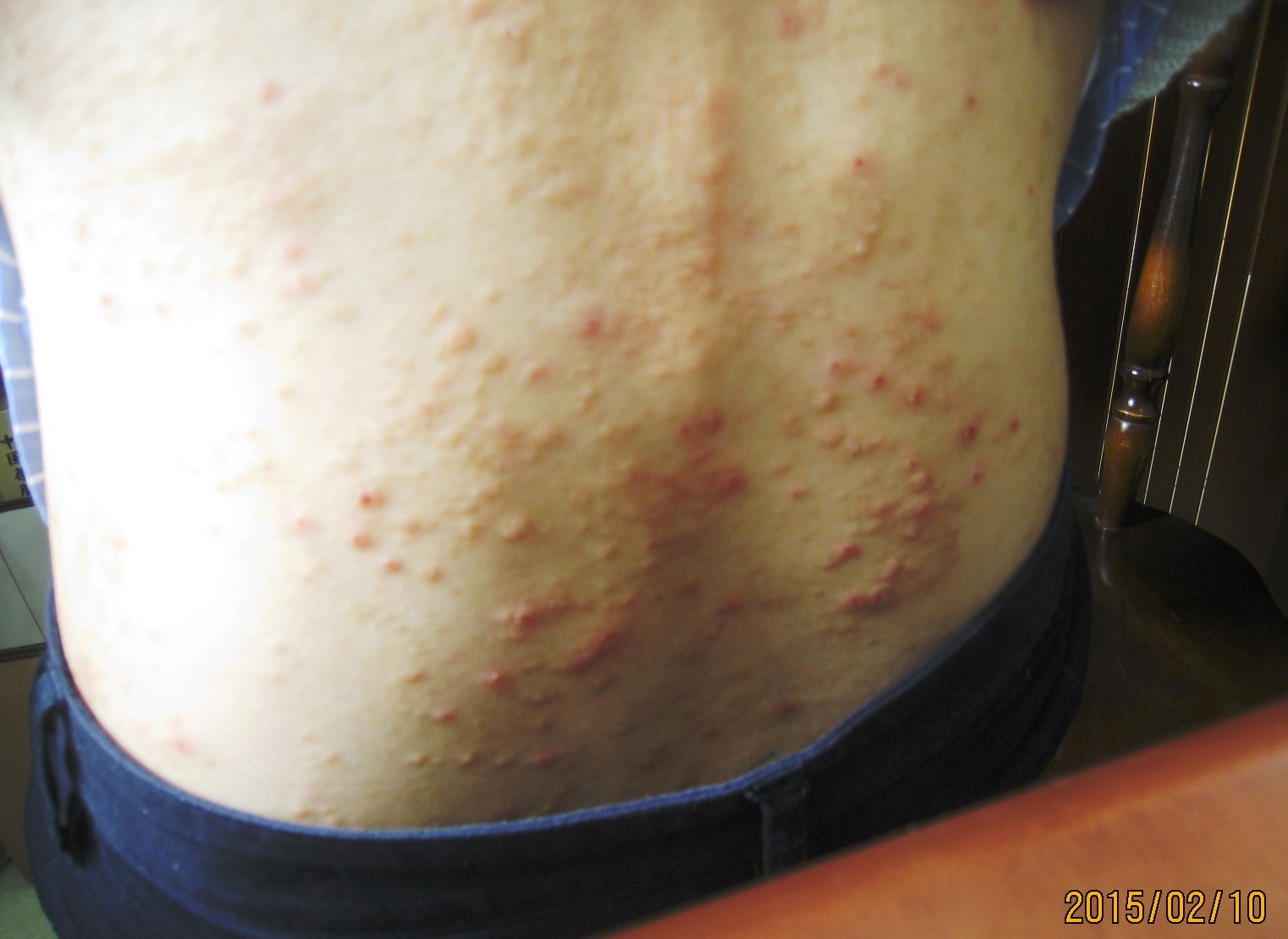 痒疹状アトピーが漢方でよくなりました。