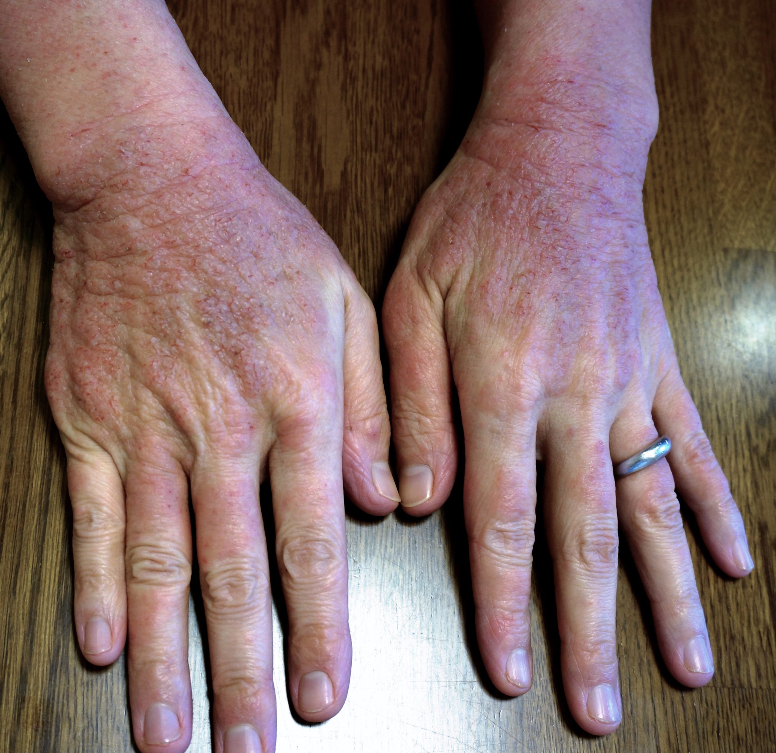 漢方で、アトピーが早く良くなりました。