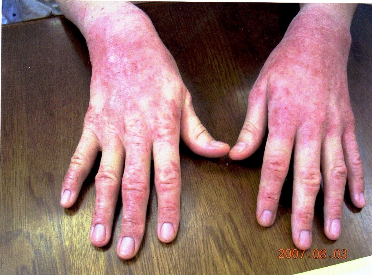アトピーでじくじくの手がステロイドなしできれいになりました