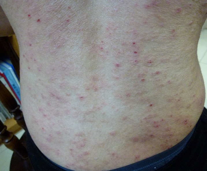 アトピーの完治に向けて。