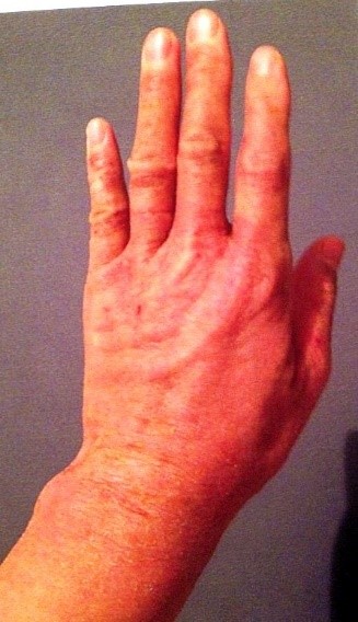 酷かったアトピーが、半年後には白くツルツルになりました。