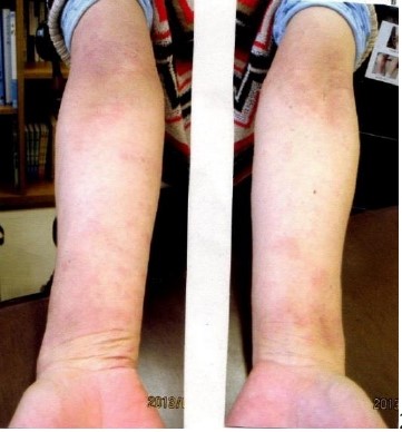 痒みで眠れなかったアトピーが改善