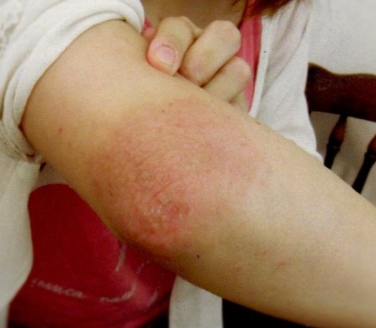 アトピーを治す希望が持てた