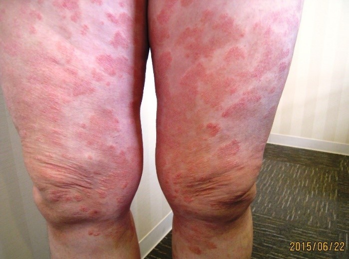 尋常性乾癬が漢方で綺麗になった