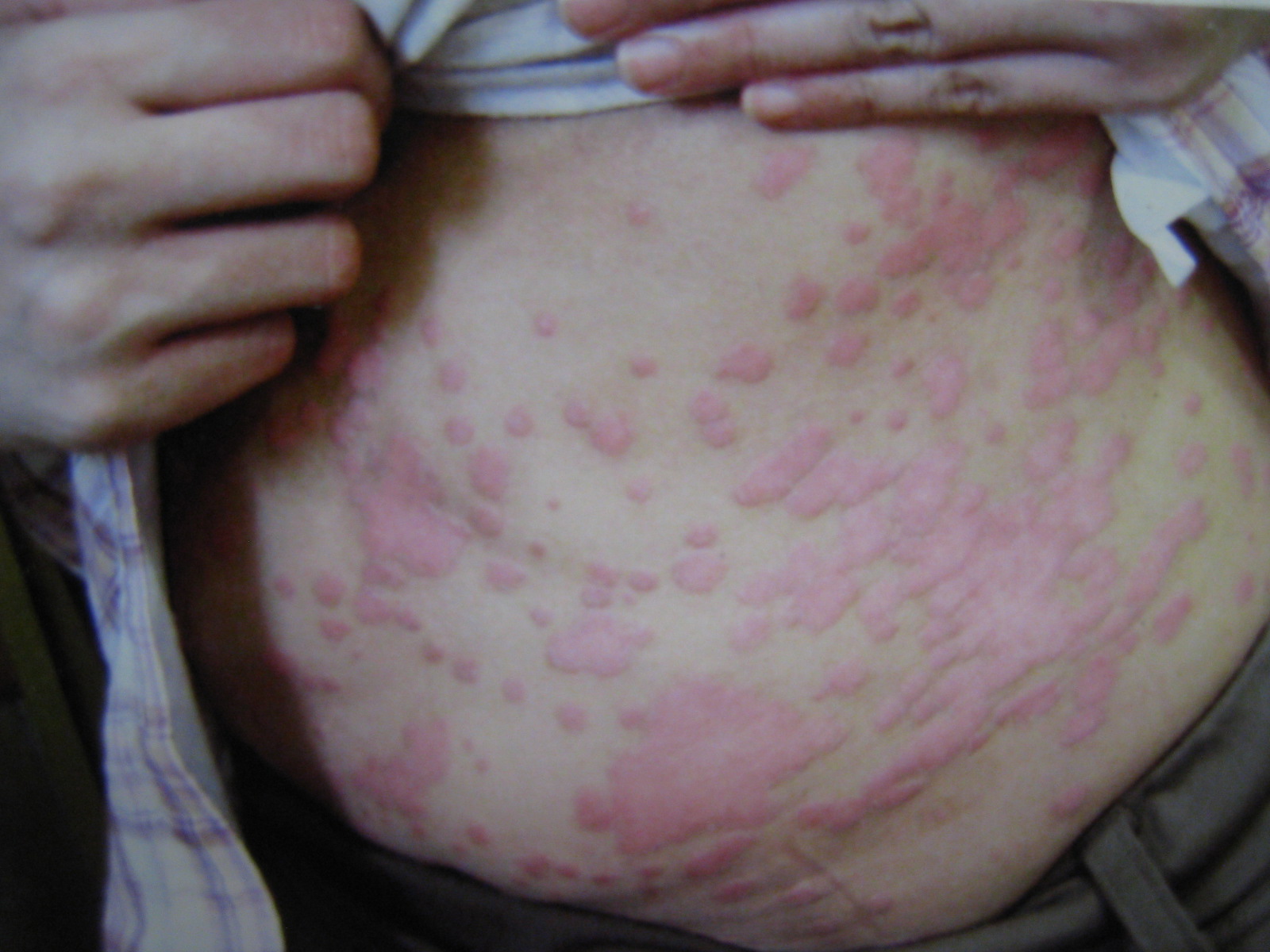 尋常性乾癬でも改善できる