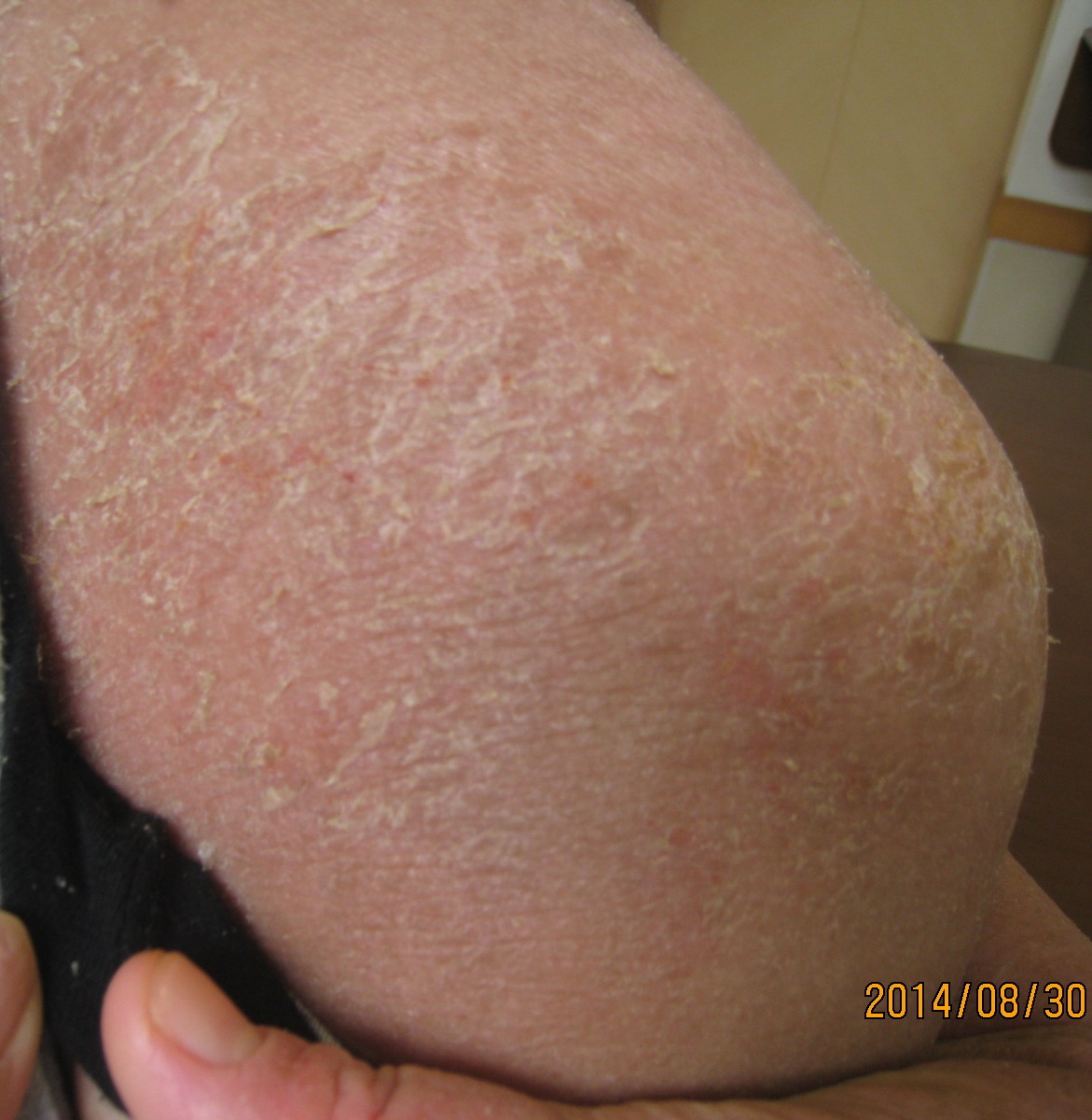 ステロイドで、ぼろぼろになりましたが、漢方で改善しました。