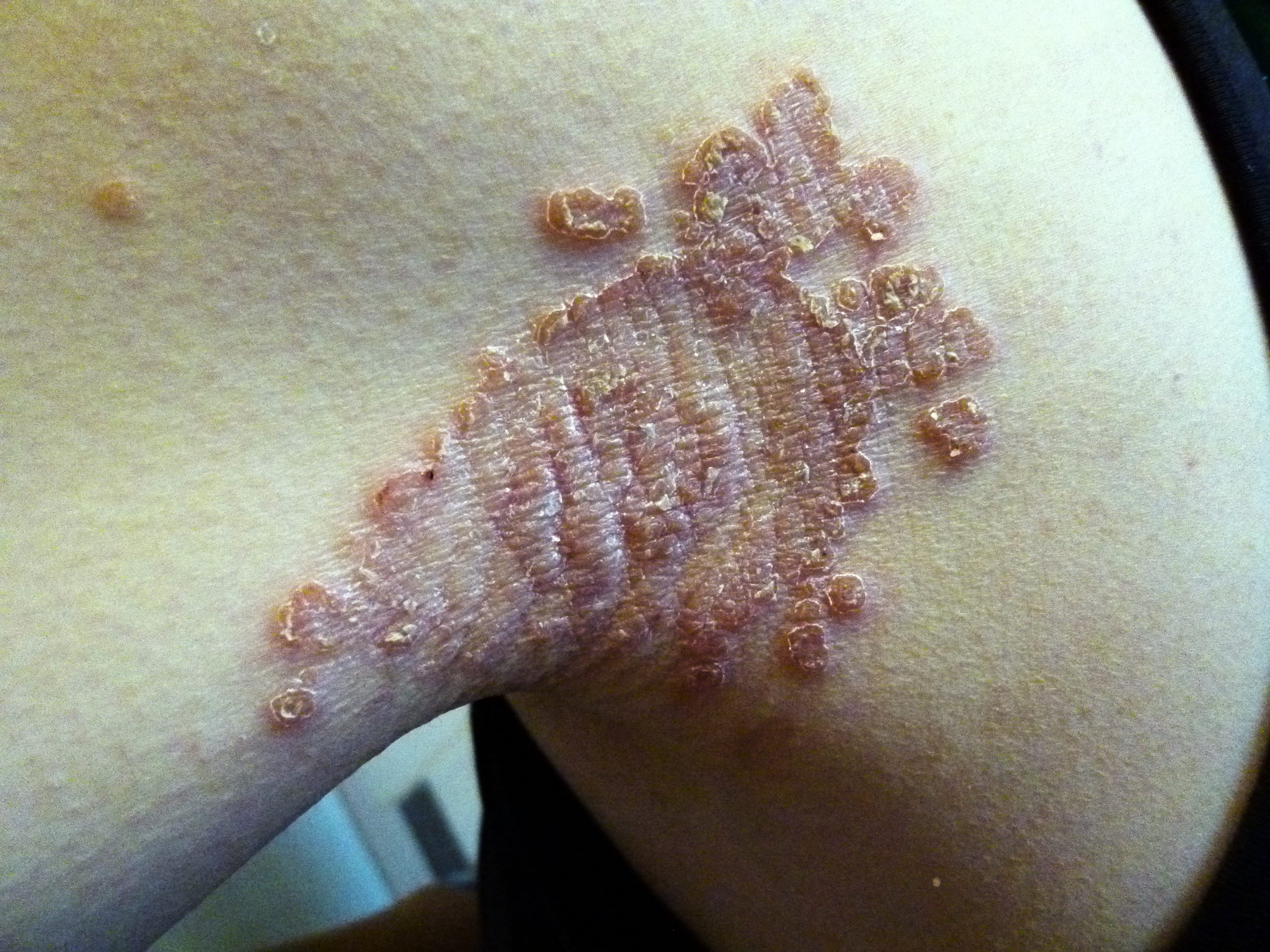 食べ過ぎでジクジク湿疹が出来たが、漢方で改善