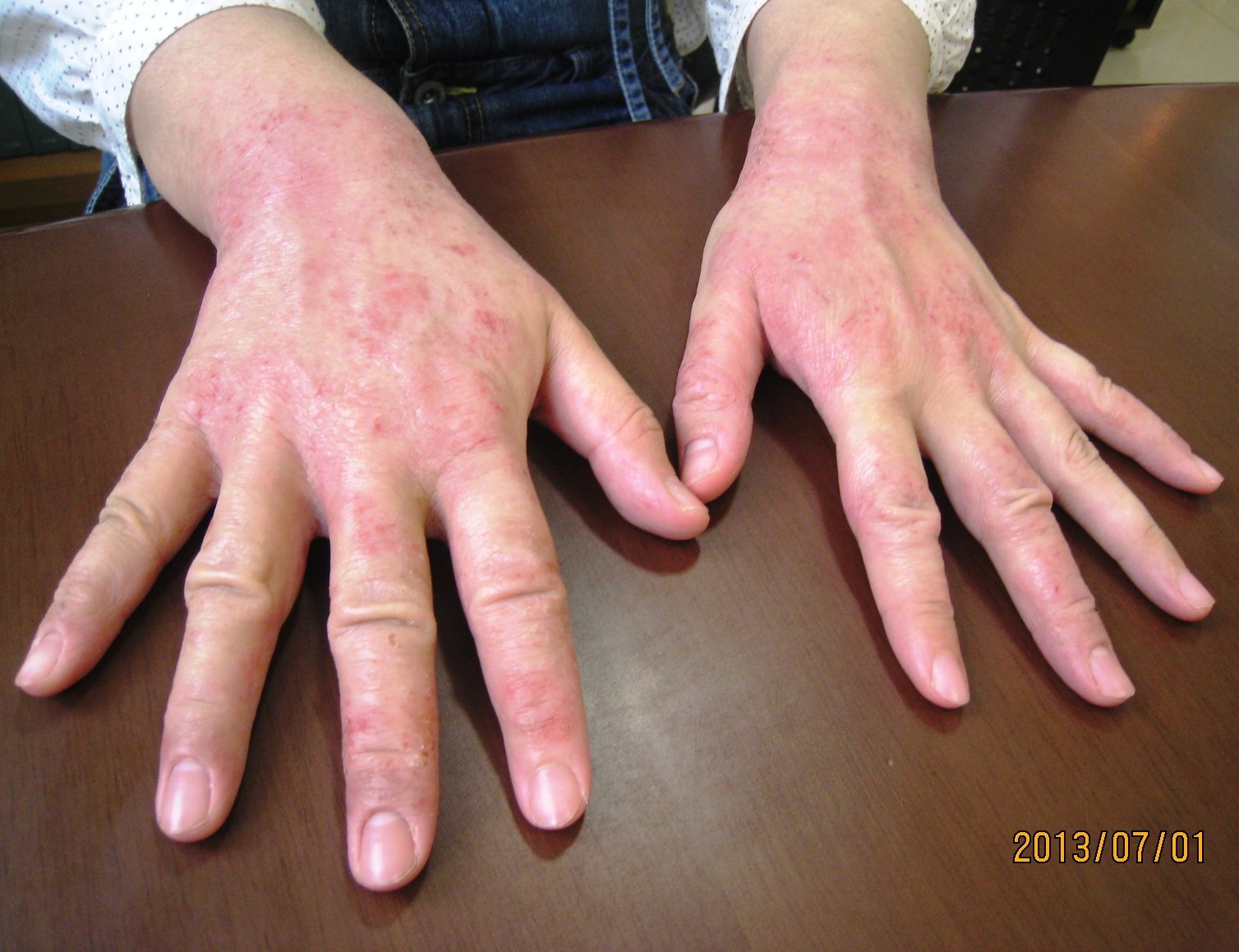 全身乾燥でかゆみがひどかった肌が漢方で改善しました。