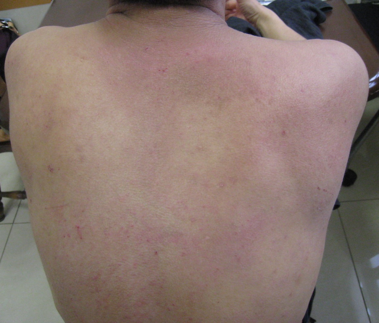 15年近く良くならなかったアトピーが3か月で楽になりました！