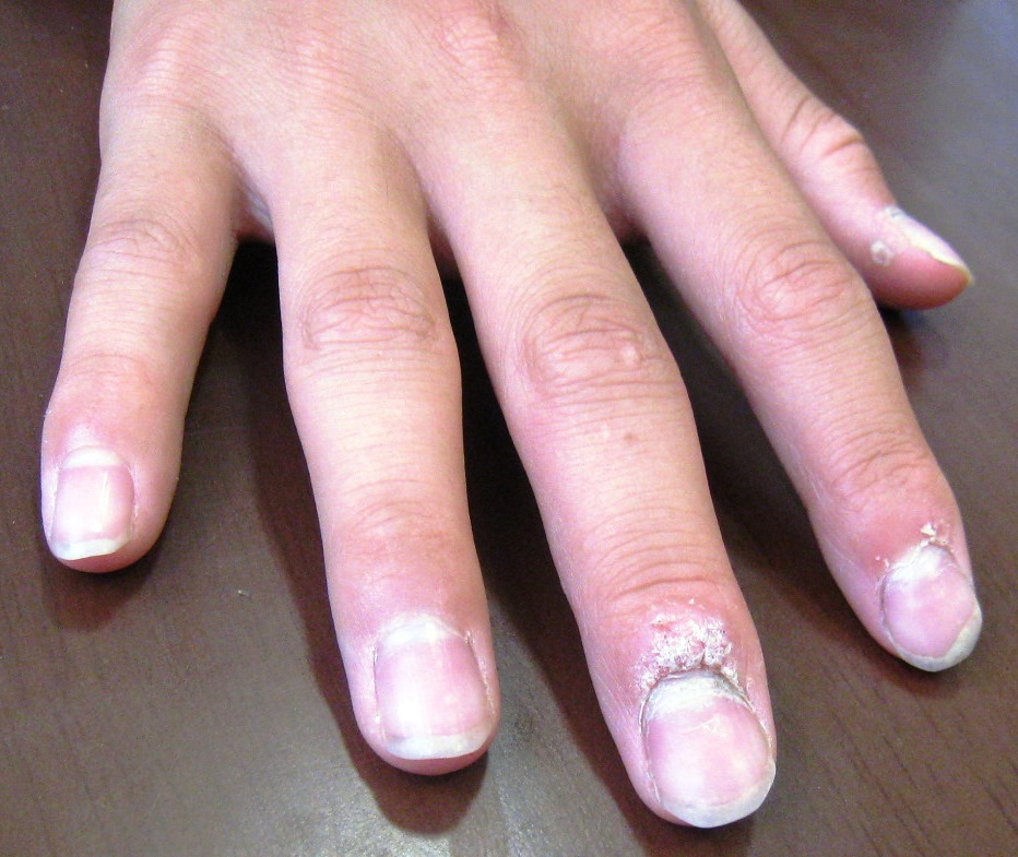 子供のイボが、６か月でとれました