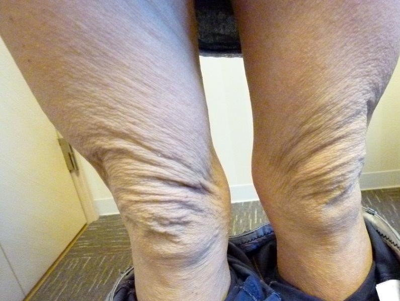 脱ステをしてアトピーが更に悪化。漢方でやっと落ち着きました。