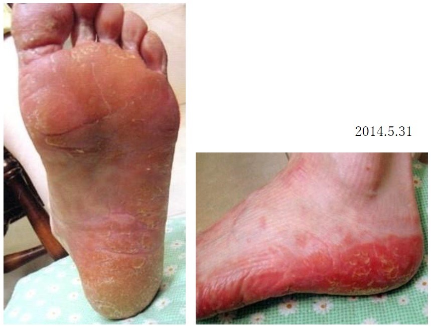 掌蹠膿疱症が漢方ですっかりよくなりました。