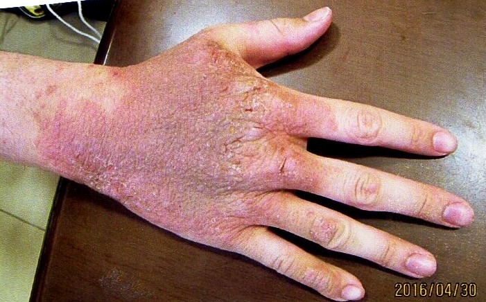 長年の頑固なアトピーが真面目に漢方を飲んで早く治りました。