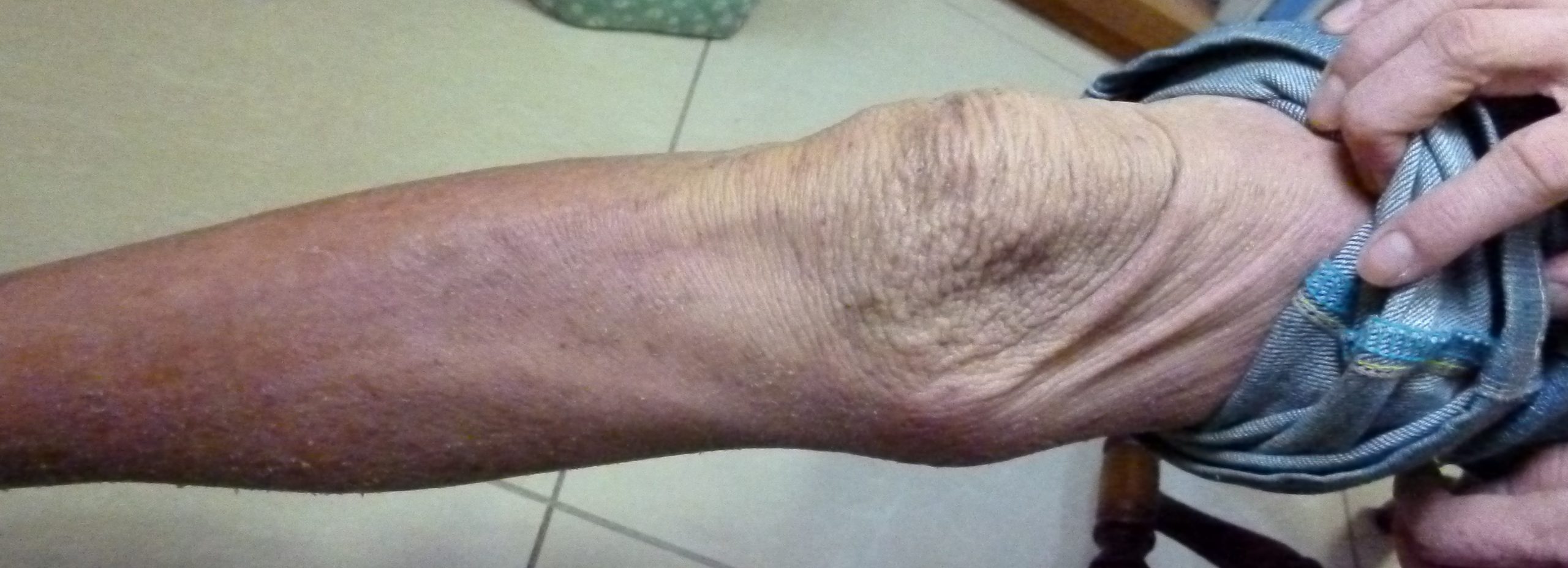 脱ステ後、漢方でアトピーがよくなり、生きるのが楽になりました。