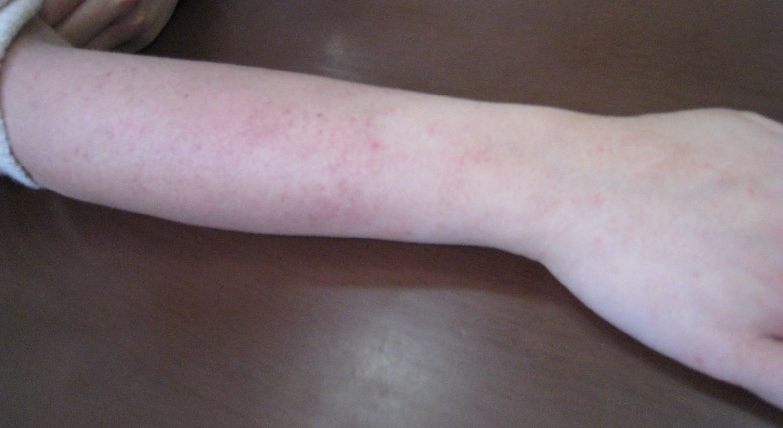 生理痛、便秘が治ると同時にアトピーも良くなりました。