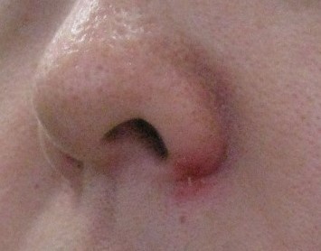 帯状疱疹は漢方薬で良くなります。