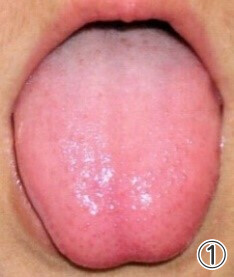 舌は健康のベロメーター:舌診