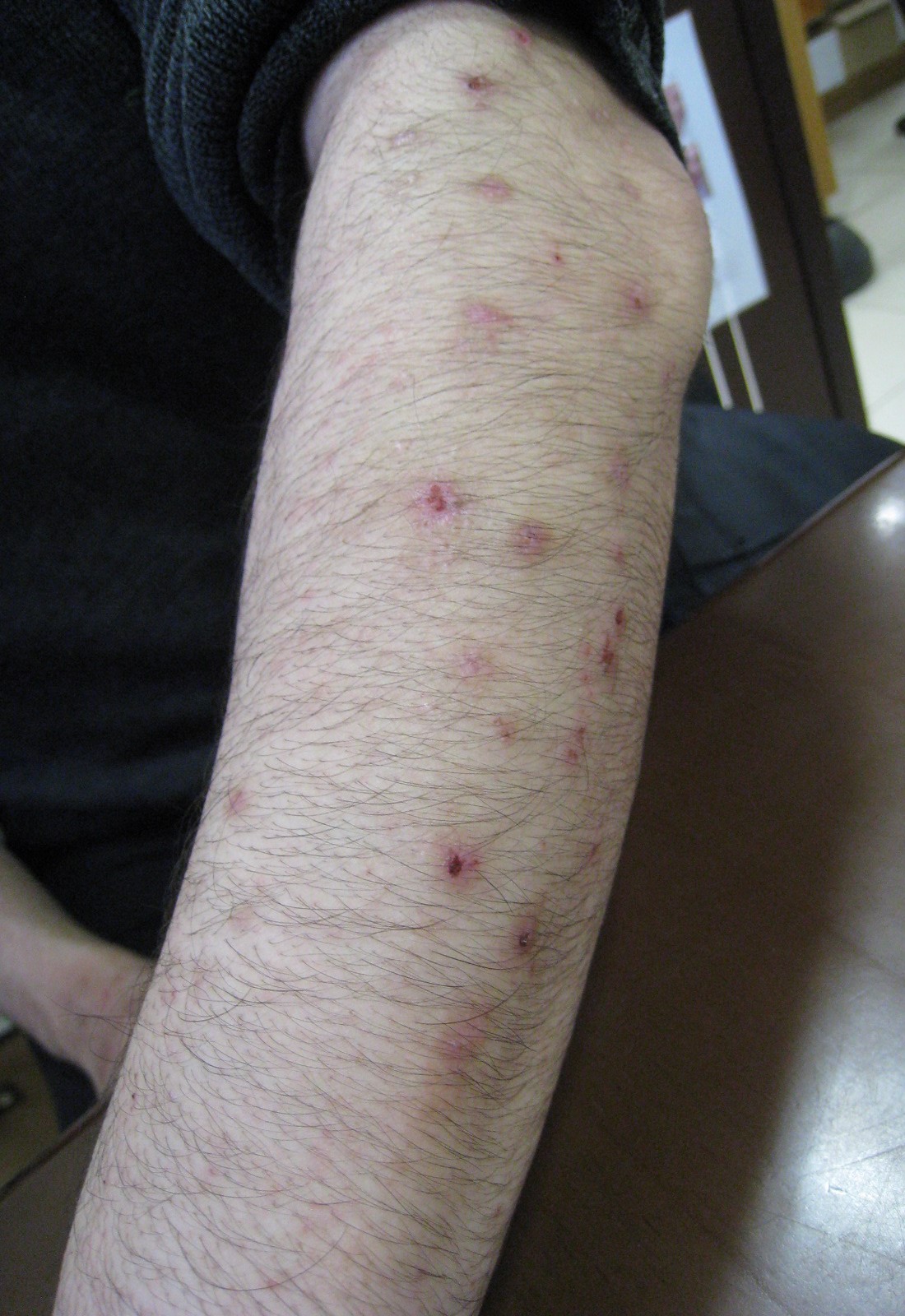 痒みのひどい痒疹が半年で楽になりました。