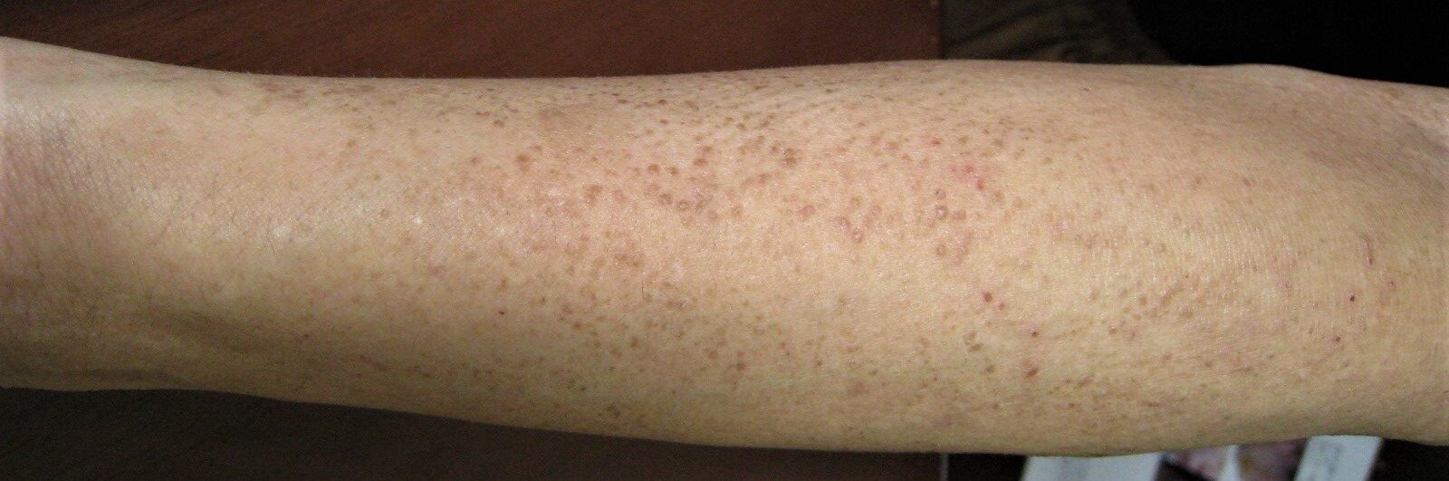 アミロイド苔癬が漢方できれいに