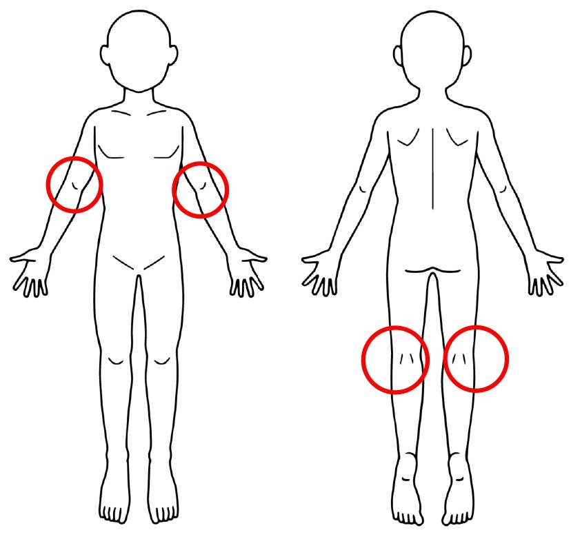 水疱や顔の赤みのアトピーの養生