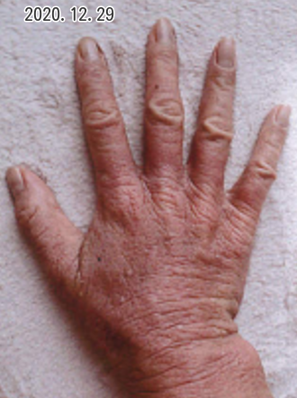 ステロイドのリバウンドを漢方で克服して