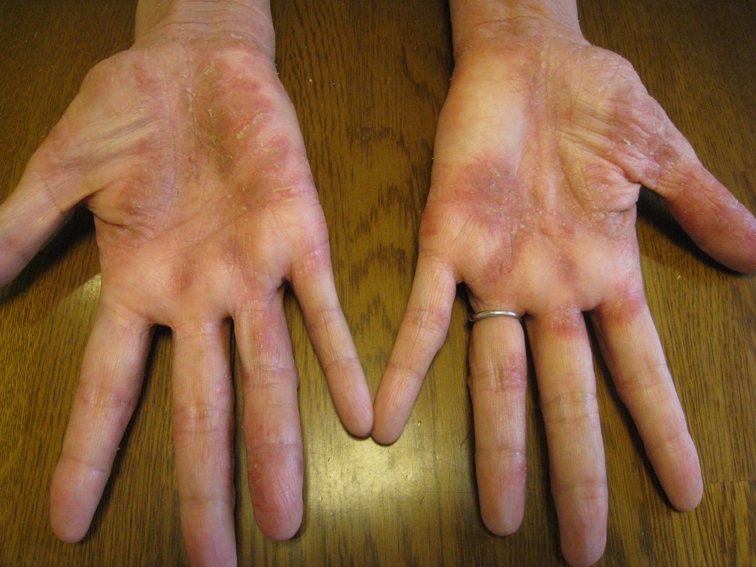 顔に出たアトピーが漢方煎じ薬でよくなり、元気がでてきました