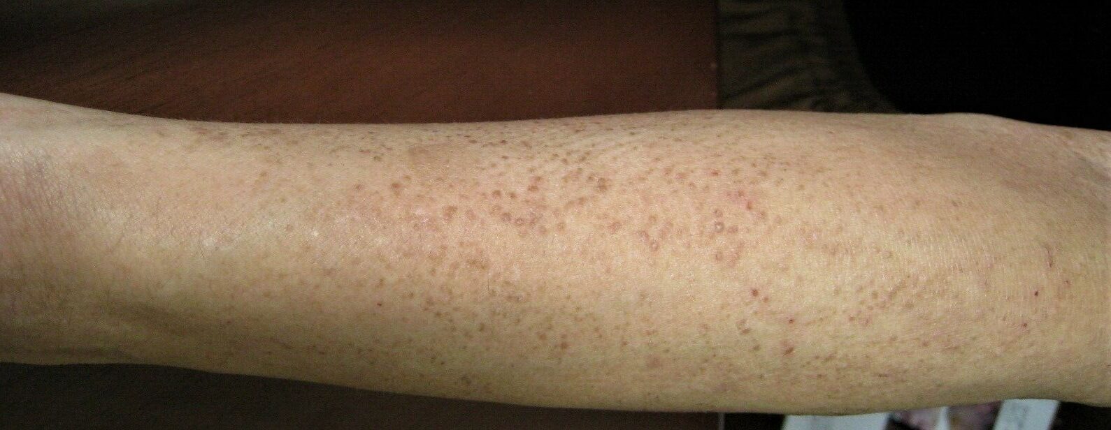 アミロイド苔癬を漢方で治そう