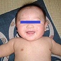 子供のアトピー、不十分な胃腸の働き