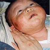 アトピーの赤みの原因は「熱」