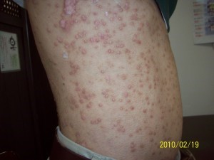 皮膚と大腸の意外な関係