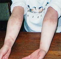 アトピーがリバウンドの後、急に好転