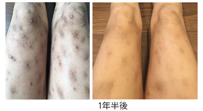 痒疹が漢方で改善し感謝の声